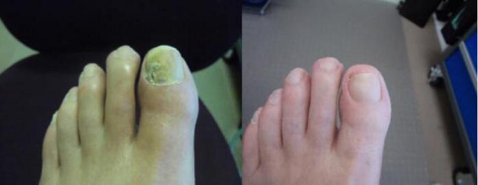 Foto dei piedi prima e dopo l'utilizzo della crema Zenidol