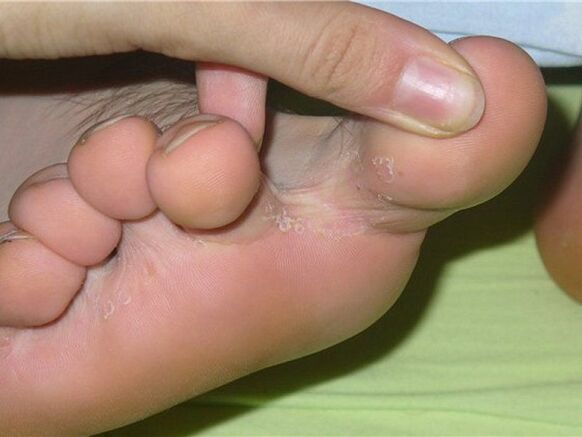 sintomi del fungo dell'unghia del piede