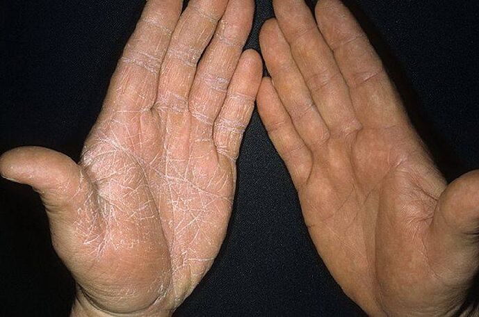 sintomi di un fungo sulla pelle delle mani