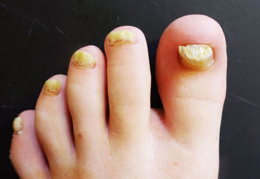 Aspetto sgradevole delle unghie dei piedi colpite da funghi