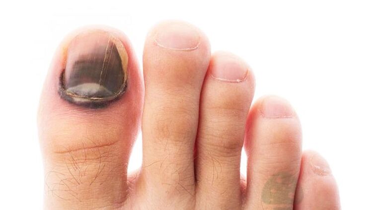 stadio avanzato della malattia con un fungo dell'unghia del piede