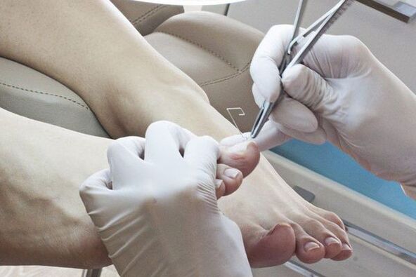 Rimozione meccanica delle unghie dei piedi colpite da funghi