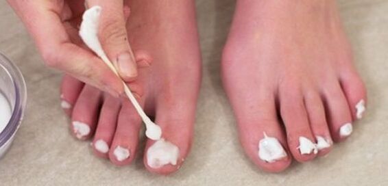 trattamento fungo dell'unghia del piede con unguento