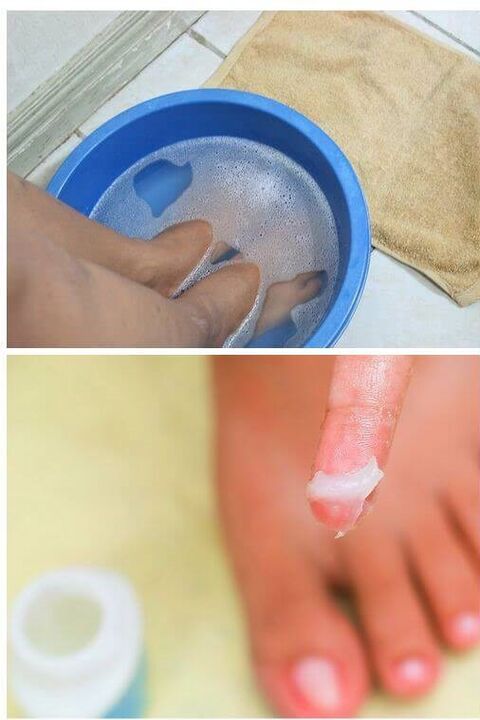l'uso di oli naturali nel trattamento del fungo dell'unghia del piede
