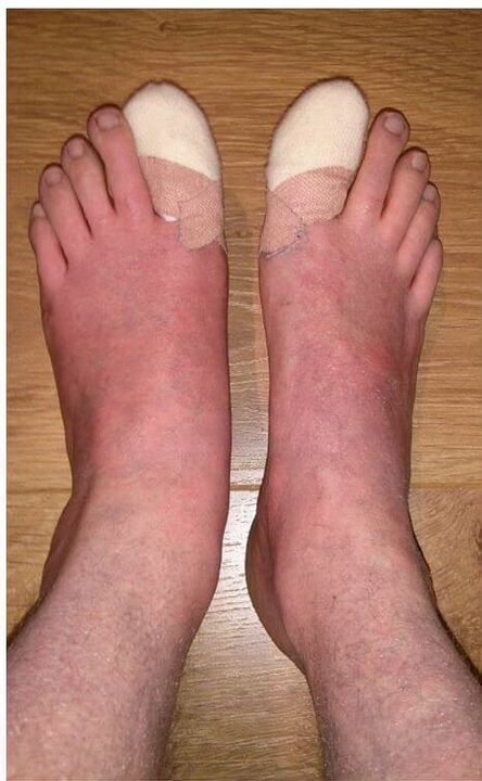 rimozione delle unghie dei piedi colpite da funghi