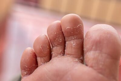 sintomi di infezioni fungine delle dita dei piedi